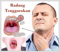 Ada beberapa gejala yang dialami seseorang saat alami radang tenggorokan seperti sakit saat menelan, munculnya demam ringan, batuk dan pembengkakan. Obat Tradisional Sakit Menelan Radang Tenggorokan Alodokterqnc