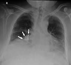 Pleural effusion refers to a buildup of fluid in the space between the lungs and the chest cavity. Antero Posterior Chest X Ray Showing A Small Bilateral Pleural Download Scientific Diagram