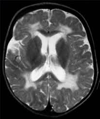 Chronic White Matter Disease Ehow White Matter Brain Issues Disease