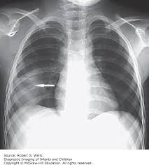 Image result for Pulmonary Contusion