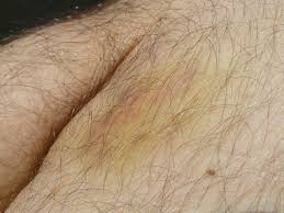 Meistens werden sie durch stürze, stöße. Bluterguss Hamatom Ursachen Beschwerden Diagnose Behandlung Prognose Vorbeugung Gesundmed Medizin Und Gesundheit Im Web