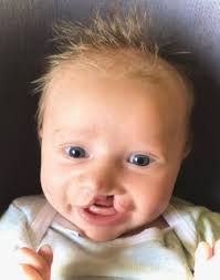 Joanna Webster is fundraising for Cleft Lip And Palate Association