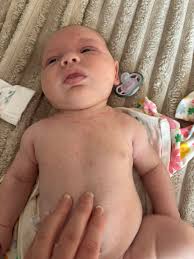 Dear Mummies, How do you solve d lo rashes at d neck area which skin fold?  Already put cream, powder still hv rashes