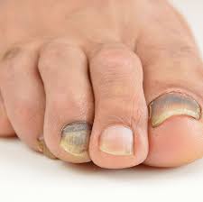 It can make your toenail change color or get thicker. Soccer Toes The Ugly Truth Girls Soccer Network