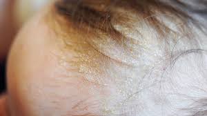 Image result for Cradle Cap