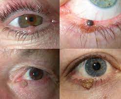 Can you spots the signs? Racgp Eyelid Lesions In General Practice
