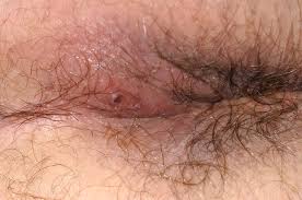 Image result for Perianal Abscess