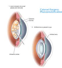 Image result for Cataract Extraction