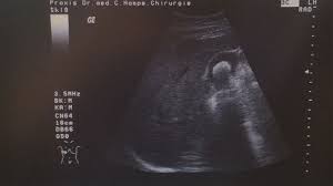 Da sie jedoch nicht lebensnotwendig ist, können patienten recht gut. Entfernung Der Gallenblase Chirurgische Orthopadische Praxis