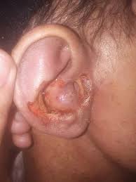 Trigeminal Trophic Syndrome Wikipedia