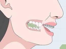 But just remember that when it does hurt its going to stop and. Expert Advice On How To Eat Food With New Or Tightened Braces