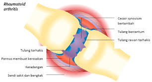 Rheumatoid Arthritis Portal Myhealth