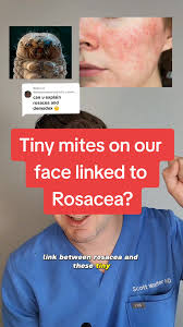 Image result for demodex rosacea