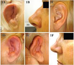 Image result for Relapsing Polychondritis