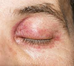It is more common as we age as the eyelid skin and muscles lose tone. Eyelid Twitch Common Causes Treatment And Prevention