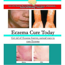 I also have that with acne. Eczema Cure Today Get Rid Of Eczema Forever Natural Ways To Cure Eczema Skin Care Service Facebook 16 Photos