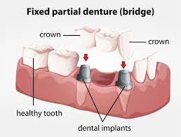 A missing tooth can do more than just cause a gap in your smile. How Much Does A Dental Bridge Costs In The Usa