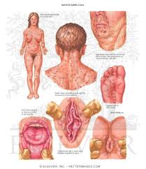 Image result for Secondary Syphilis