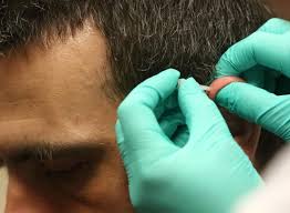 Battlefield acupuncture gives veterans alternative to drugs for pain relief 