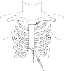 Reversible Causes Of Cardiac Arrest Chapter 2 Perioperative Drill Based Crisis Management