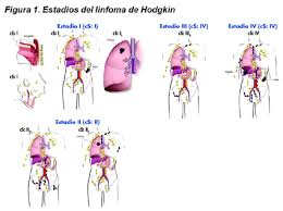 Se conocen bajo este nombre las enfermedades en las que las células que se malignizan son células. Linfoma De Hodgkin Seom Sociedad Espanola De Oncologia Medica C 2019