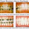 How long does it take to close upper 1st bicuspid extraction gaps with braces? 1