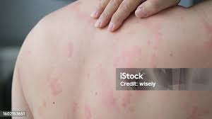 Image result for Papular urticaria