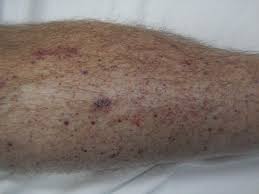symptoms of skin metastases include: Skin Cancer And Rashes Cancerous And Precancerous Lesions