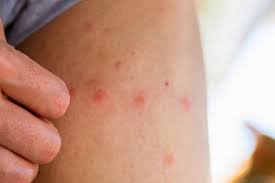 Image result for mosquito bite