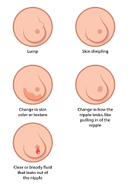 They are often irregularly shaped as opposed to a sphere or ball shape. File Breast Cancer Illustration En Svg Wikimedia Commons