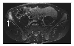 Image result for Hip Apophysitis