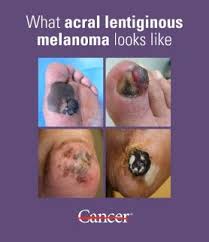 Image result for Acral lentiginous melanoma nail