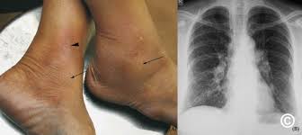 Image result for erythema nodosum