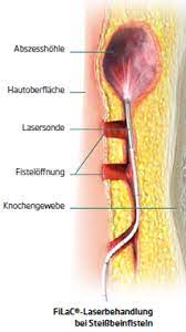 Lasertherapie Bei Steissbeinfistel Kleine Wunde Keine Schmerzen Zentrum Fur Proktologie Berlin