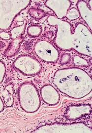 May 07, 2020 · cancer immunotherapies have changed the landscape of cancer treatment during the past few decades. Thyroid Nodules In Diagnostic Pathology From Classic Concepts To Innovations Intechopen