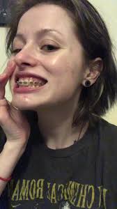 One month in :p #adultbraces #braces #teeth