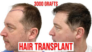 Brian O etter hårtransplantasjonen sin