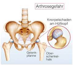 Huftarthroskopie Diagnose Und Therapie Von Huftschmerzen Gelenk Klinik De