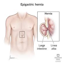 Image result for Hernia Reduction