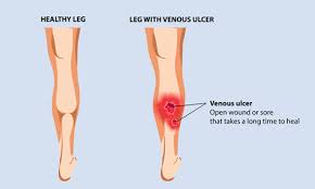 What Are Venous Leg Ulcer Heavylegs In