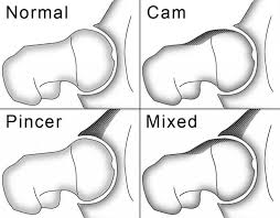 Femoroacetabular Impingement (FAI) - a.k.a. Hip Impingement | Orthopedic Center for Sports Medicine