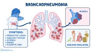 Maybe you would like to learn more about one of these? Bronchopneumonia What Is It Contagiousness Diagnosis Treatment And More Osmosis