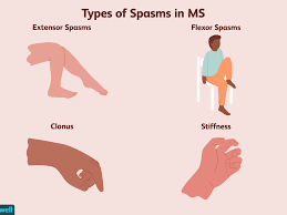 Muscle Spasticity And Stiffness As A Symptom Of Ms