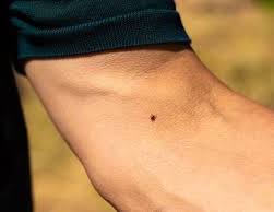 Tick Bites: Symptoms, Treatments, Pictures, and Prevention