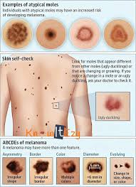 You have brown spots on your. Knowitezy Knowitezy Melanoma Melanoma The Most Serious Type Of Skin Cancer Develops In The Cells Melanocytes That Produce Melanin The Pigment That Gives Your Skin Its Color Melanoma Can