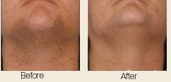 Laser hair removal works by using light energy to permanently disable the hair follicle. Laser Hair Removal In Boston Wellesley Ma Christopher Davidson Md