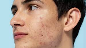 Image result for acne face