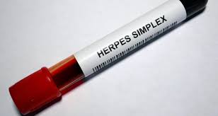 Genitalherpes Schutz Und Behandlung Docmorris Blog