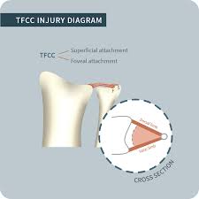 Image result for Triangular Fibrocartilage Complex Injury