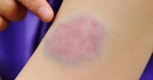 Ciltteki Morarmalarin Nedenleri Saglik Haberleri